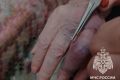 В Казани спасатели сняли кольцо с опухшего пальца 89-летней женщины