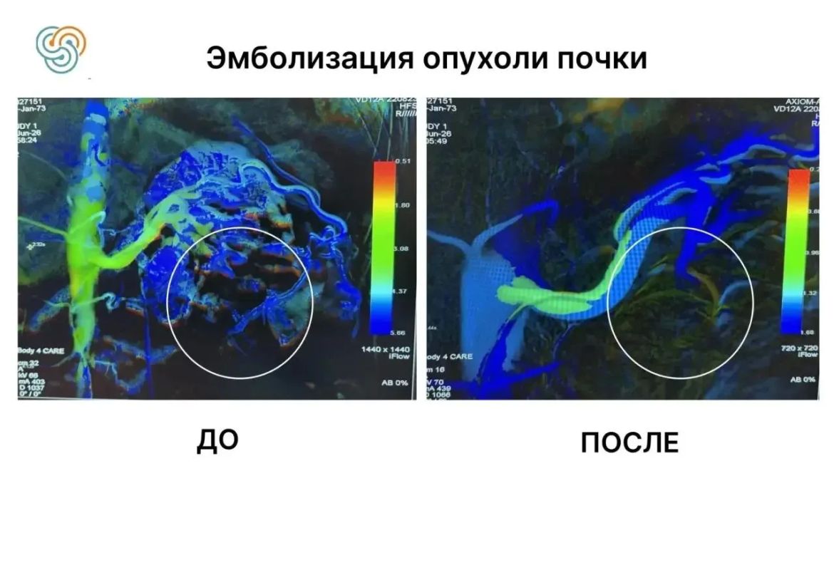 После пяти инсультов, инфаркта и протезирования клапанов сердца любое хирургическое вмешательство для пациента Республиканского клинической онкологического диспансера им проф После пяти инсультов, инфаркта и протезирования клапанов сердца любое хирургическое вмешательство для пациента Республиканского клинической онкологического диспансера им проф