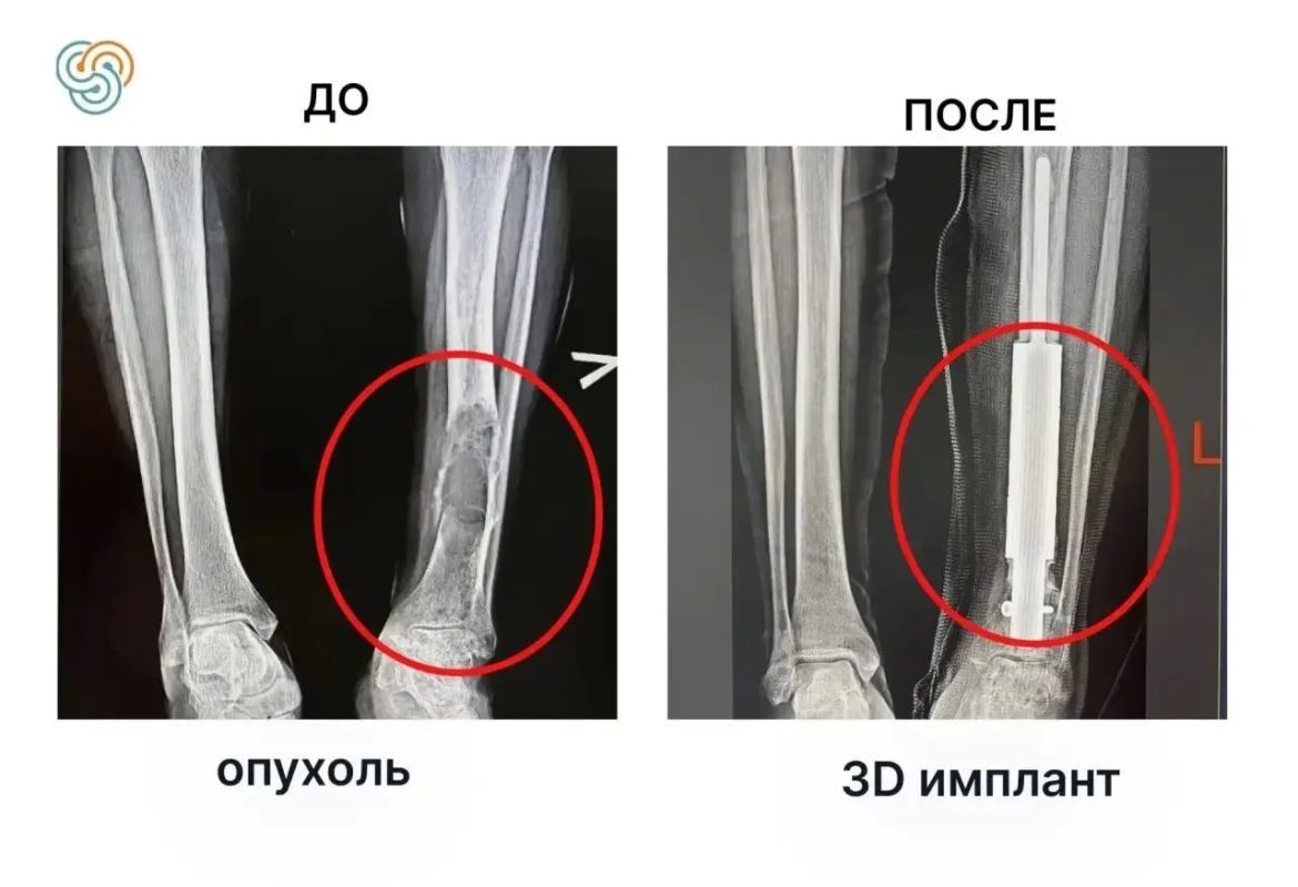 Хирурги республиканской онкологии, удалив редкую опухоль кости, заменили ее на 3D-имплант Хирурги республиканской онкологии, удалив редкую опухоль кости, заменили ее на 3D-имплант