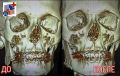 Врачи НЦРМБ провели сложную операцию по восстановлению челюсти пациенту после падения с самоката