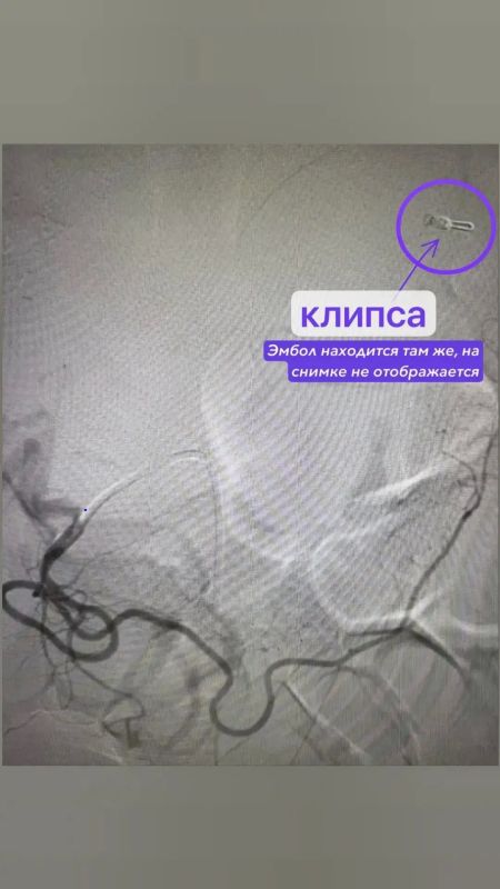 В Татарстане впервые эмболизировали артерию желудка женщине после 5 кровотечений В Татарстане впервые эмболизировали артерию желудка женщине после 5 кровотечений