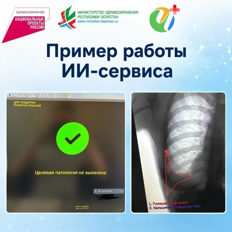 Чистопольская ЦРБ внедряет цифровые технологии будущего: передвижной флюорограф теперь работает в связке с искусственным интеллектом Чистопольская ЦРБ внедряет цифровые технологии будущего: передвижной флюорограф теперь работает в связке с искусственным интеллектом