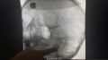 38-летняя казанка попала в РКБ с инсультом спустя три дня после визита к остеопату