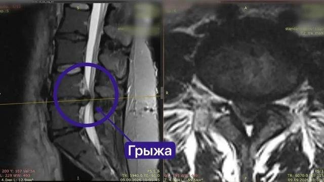 Врачи РКБ помогли беременной женщине снова ходить