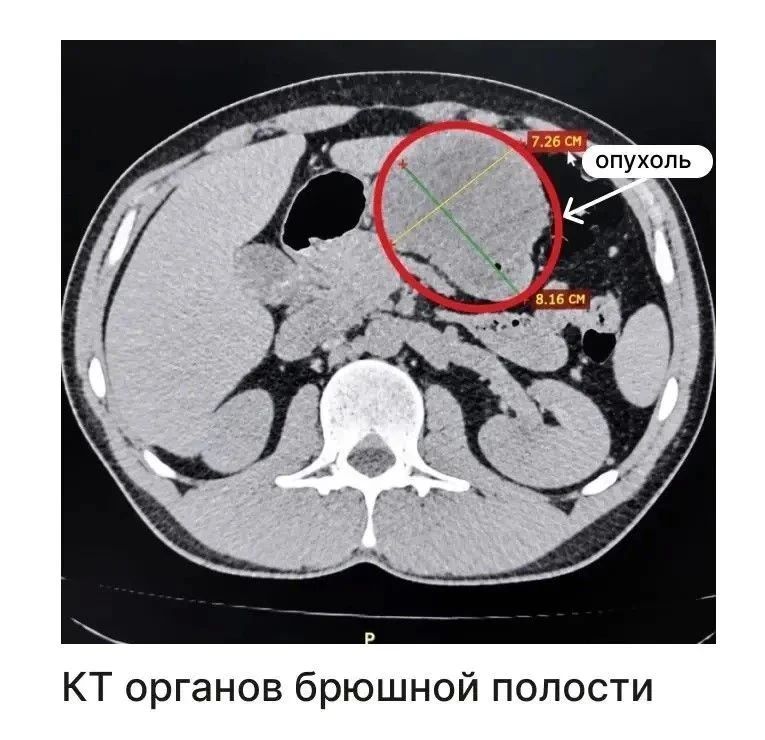Онкологи Татарстана через небольшие проколы удалили восьмисантиметровую опухоль желудка Онкологи Татарстана через небольшие проколы удалили восьмисантиметровую опухоль желудка
