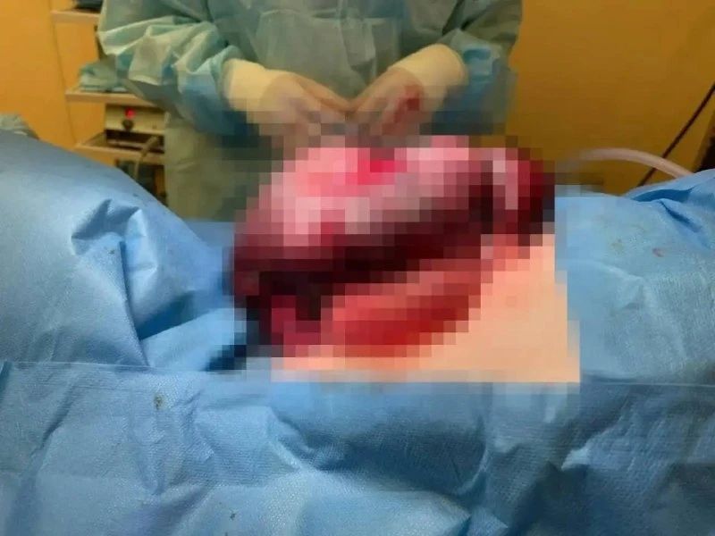 В Казани 8-летнему мальчику экстренно удалили часть кишечника В Казани 8-летнему мальчику экстренно удалили часть кишечника